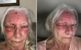 Sadece 15 dakika güneşte kaldı… Gözünü açtığında kabus başladı