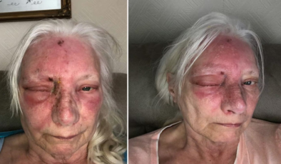 Sadece 15 dakika güneşte kaldı… Gözünü açtığında kabus başladı