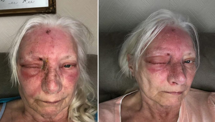 Sadece 15 dakika güneşte kaldı… Gözünü açtığında kabus başladı