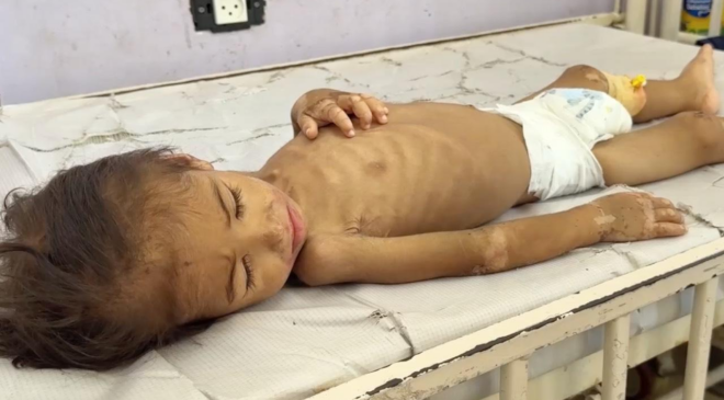 Gazze'de hastanelerdeki çocuklar adeta açlıktan ölümü bekliyor