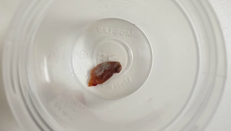 Kanserden astıma pek çok teşhis koydular: Akciğerinden çıkan şey doktorları şaşkına çevirdi